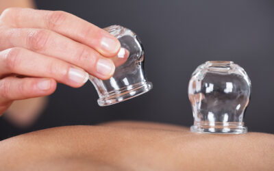 Cupping Therapy: What You Need to Know about This Infertility Treatment